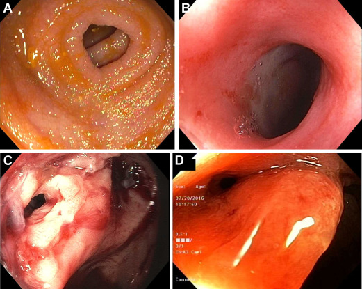 Anal Stenosis Diagram